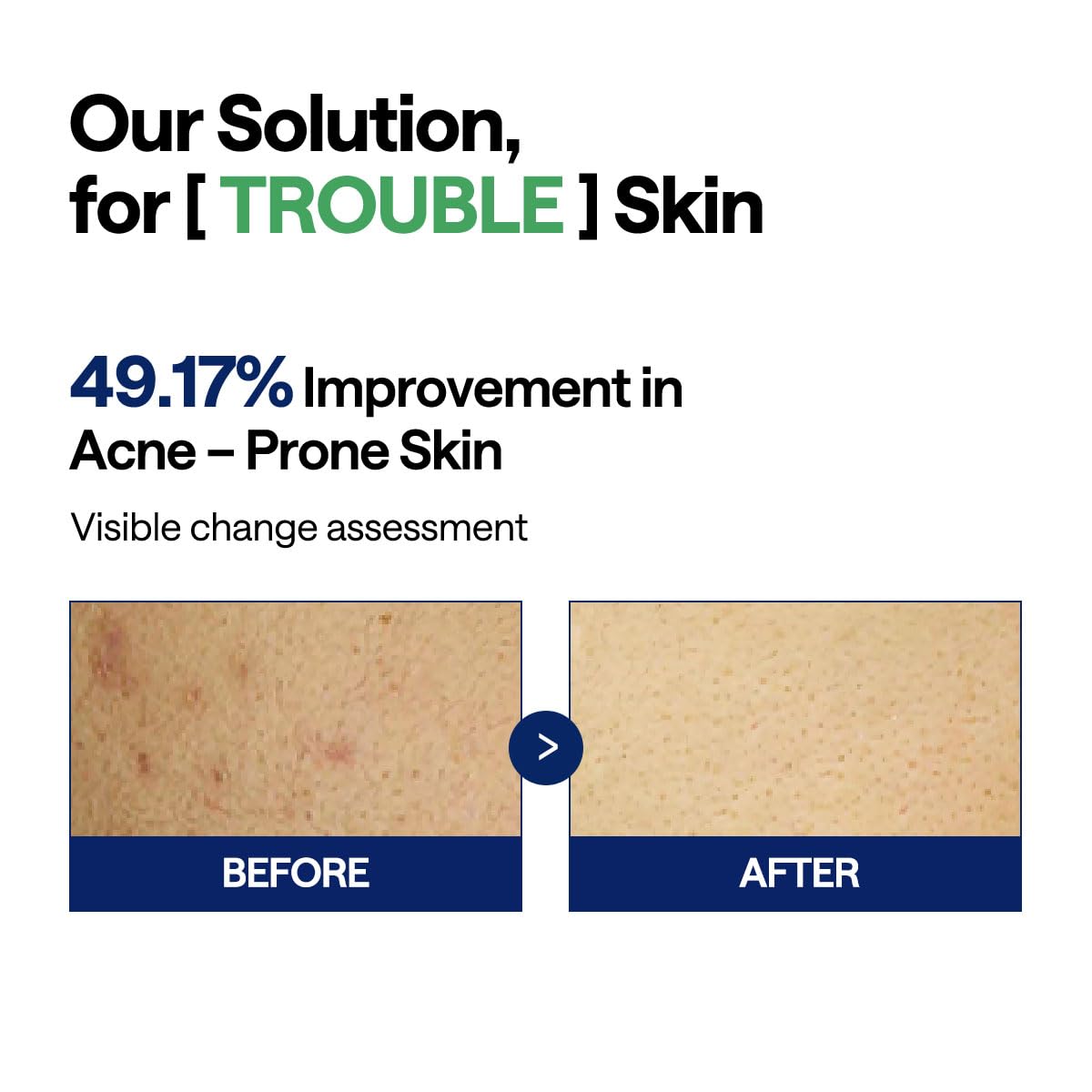 MEDIHEAL Teatree Trouble Facial Toner Pads (100 Pads)